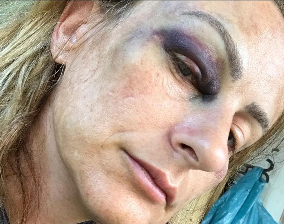 Carolina Braga com olho roxo. Ela afirma ter sido agredida por JP Azevedo quando o namorava - Foto: Reprodução/Redes sociais