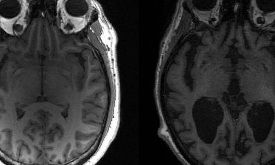 Imagem mostra cérebro saudável à esquerda e cérebro com Alzheimer à direita. Foto: Reprodução