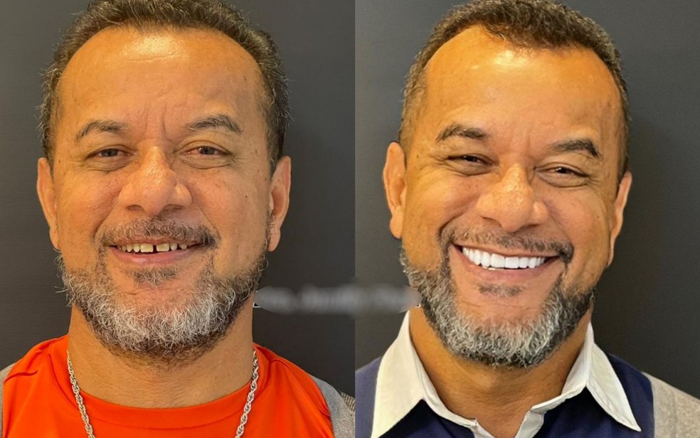 Luiz Carlos das Dores, de 56 anos, após fazer as facetas dentárias - Foto: Reprodução/TV Anhanguera