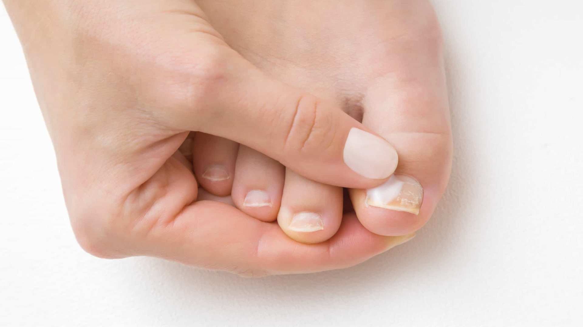 Assassino silencioso! Unhas dos pés podem indicar colesterol alto