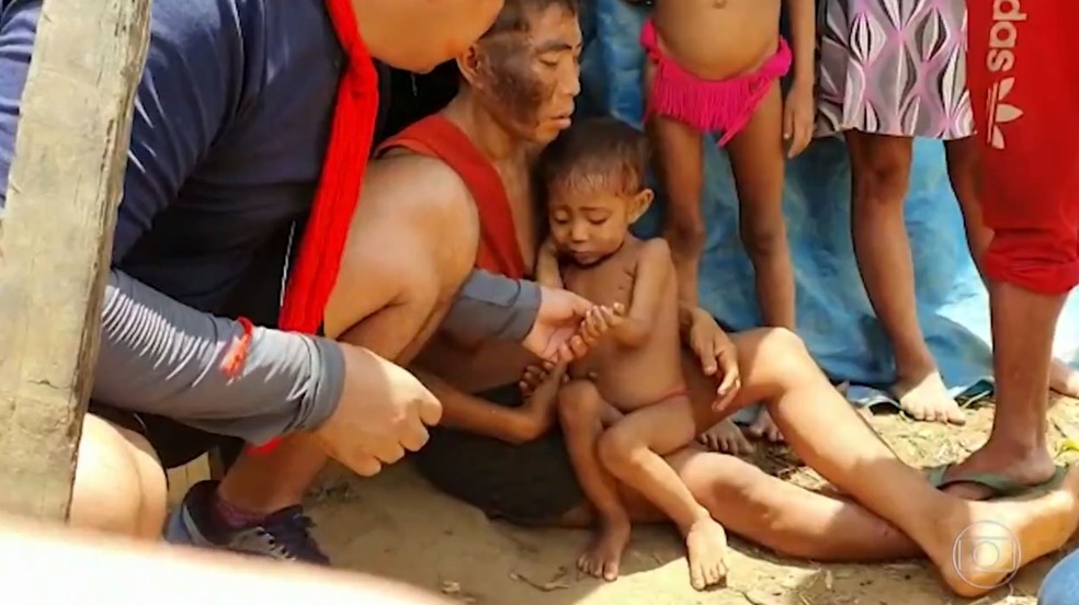 Criança que está em estado grave foi mostrada em reportagem do fantástico.  - Foto: Alexandro Pereira/Rede Amazônica